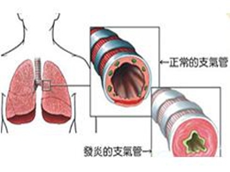 支氣管哮喘典型的臨床癥狀是