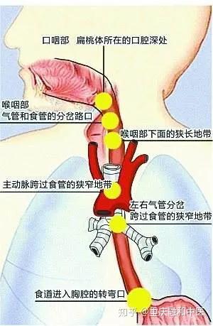 女子吃火鍋被魚刺卡喉致食管破裂