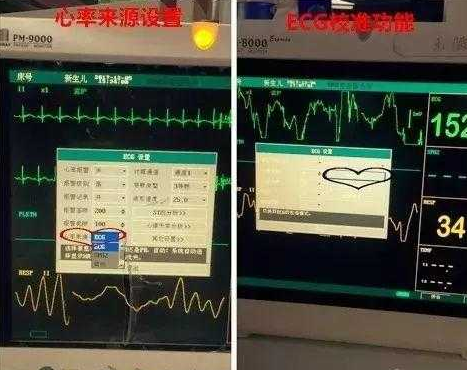 心電監(jiān)護(hù)5個(gè)電極位置