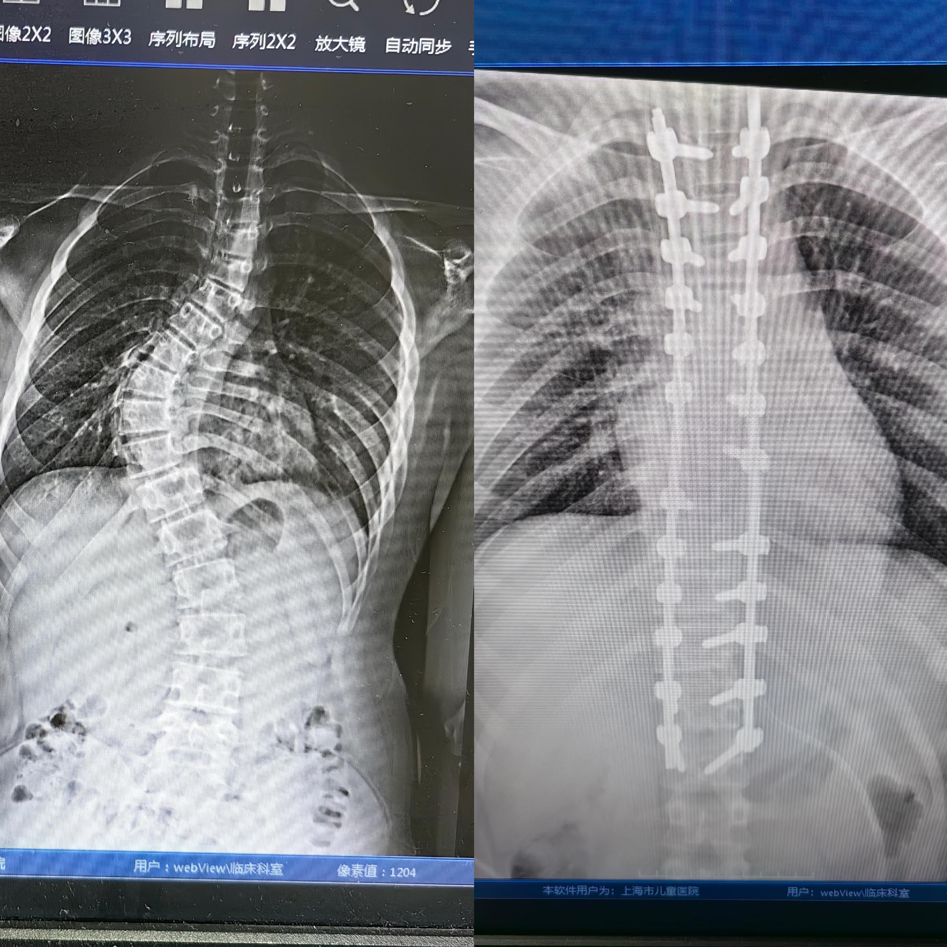 如何自測孩子是否脊柱側(cè)彎